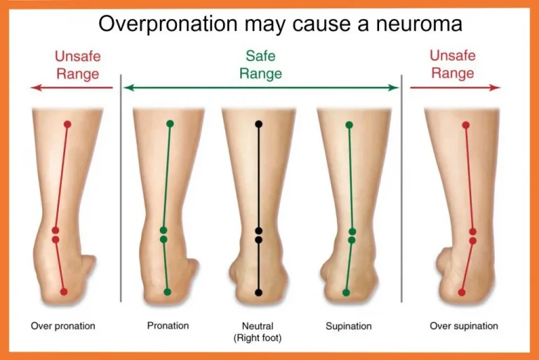 Over pronate คืออะไรทำไมต้องให้ความสำคัญ